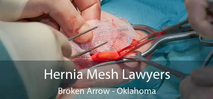 Hernia Mesh Lawyers Broken Arrow - Oklahoma