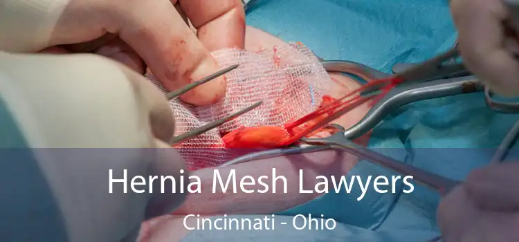 Hernia Mesh Lawyers Cincinnati - Ohio